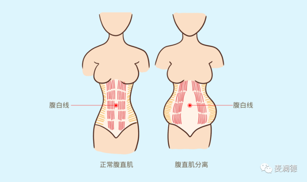 更让人头大的是:腹直肌分离的间隙逐渐被脂肪组织所填充,腹部出现明显