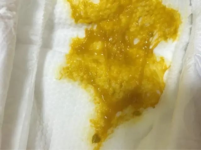 公开问题2 个月宝妈关于大便有奶瓣的提问诊断牛奶蛋白过敏可能性大