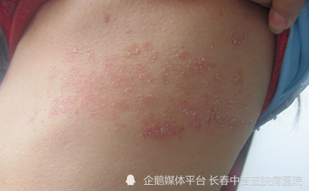 长春银屑病医院牛皮藓癣初期的患者会有什么症状