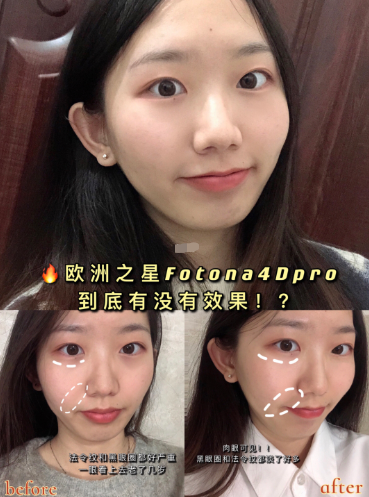 欧洲之星fotona4dpro功效反馈,效果到底好不好?