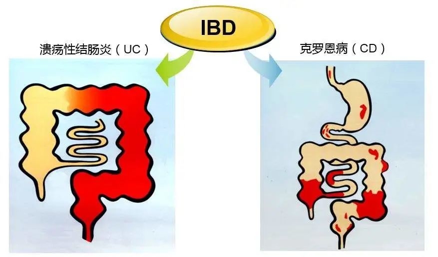 总是腹痛腹泻注意可能是炎症性肠病