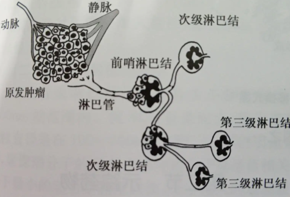 淋巴结转移的第一站,乳腺癌根治术中要对前哨淋巴结进行清扫和送冰冻