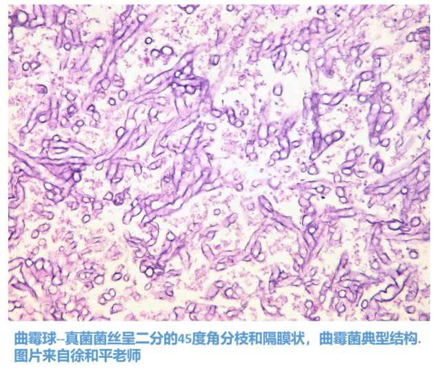 透明有隔菌丝的真菌中曲霉是最常见的,在组织切片上通常显示为细(3-12