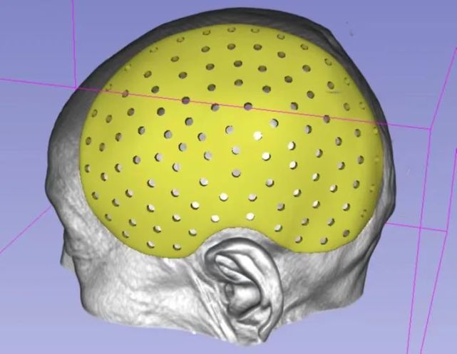术后3周联系我们,定制了颅骨缺损保护帽佩戴.