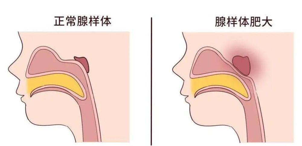 孩子腺样体肥大家长别忽视不及时治疗后果很严重