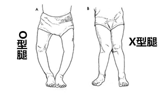 宝宝o型腿罗圈腿好尴尬3个错误行为导致宝宝罗圈腿