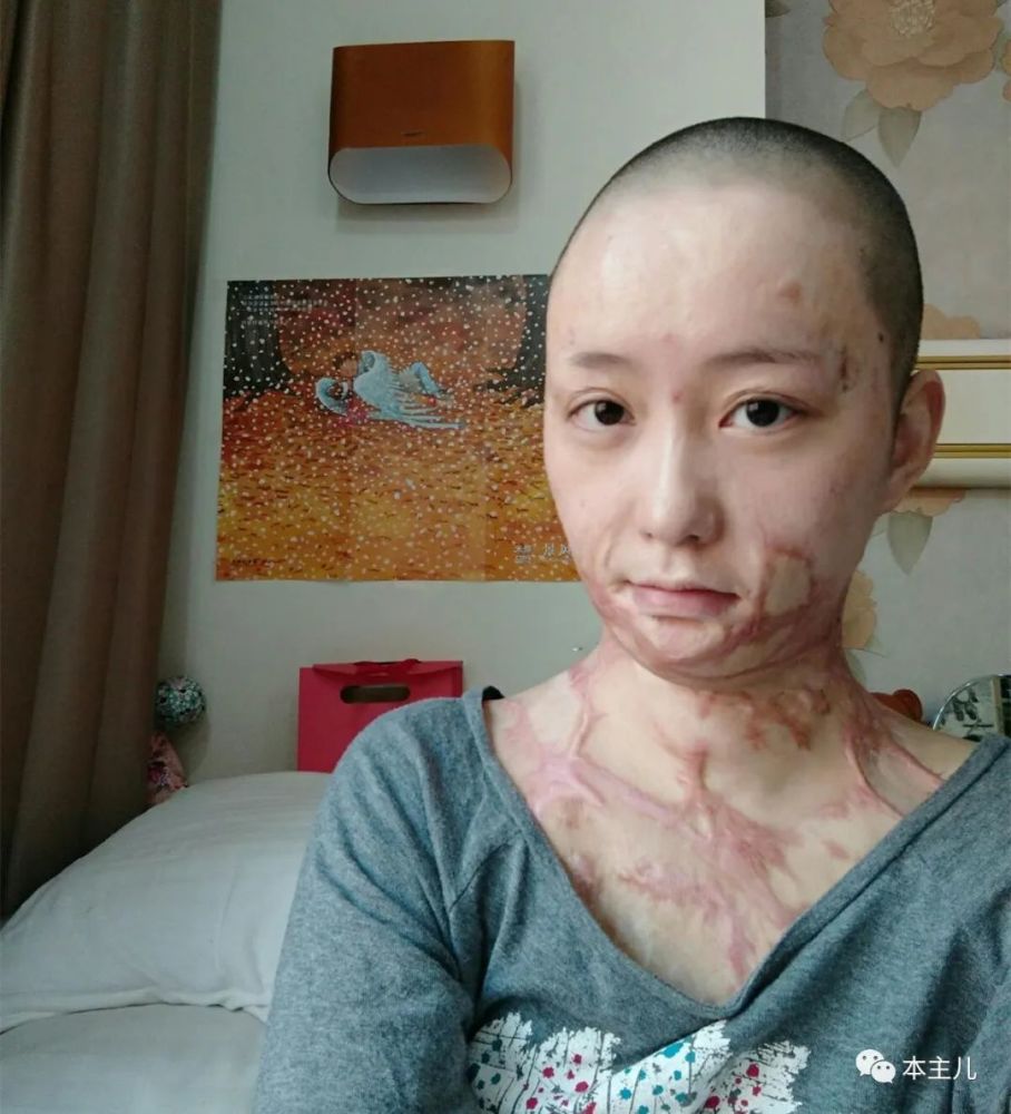 2011年被合肥官二代泼油毁容如今26岁的周岩涅盘重生