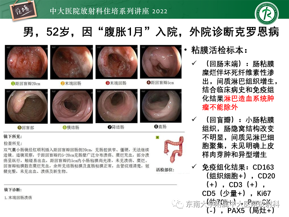 从临床关注点出发克罗恩病影像再认识