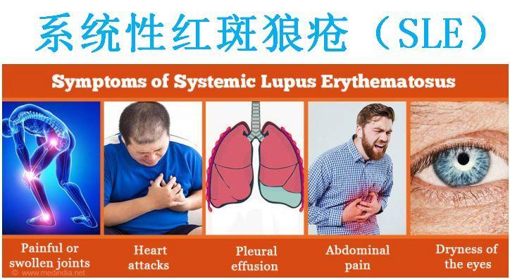 狼疮性肾炎ln的4个诊断标准不同病理类型的针对性治疗方案