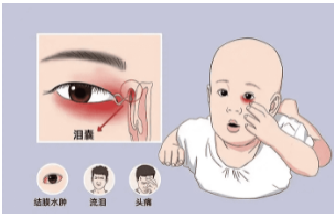 婴儿|泪腺|鼻泪管|泪道|泪囊炎