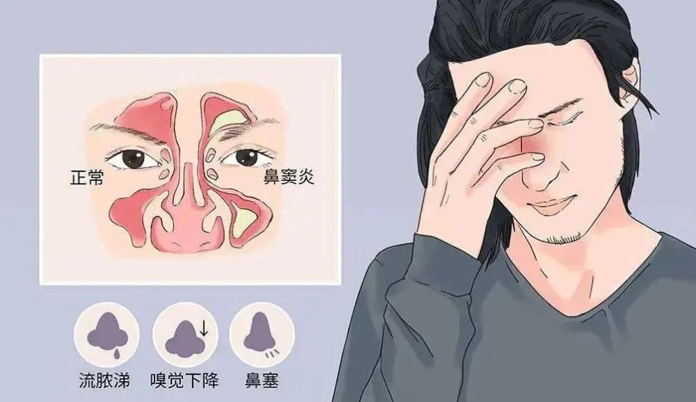 鼻炎不是鼻窦炎得了鼻炎千万不能慢待当心发展成鼻窦炎后果很严重