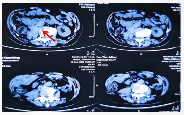 病例分享:肾癌(探界达人秀初赛西一组04)
