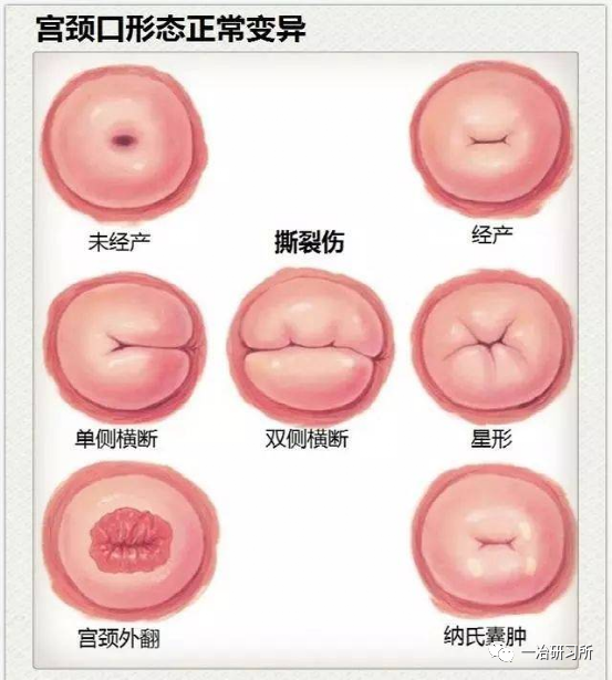 你不了解就会有人拿宫颈糜烂吓唬you