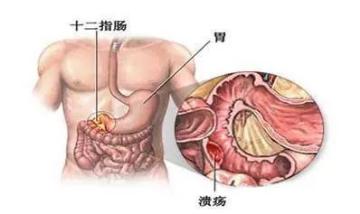 饭前饭后为何总胃疼