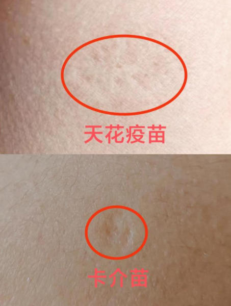 不过,胳膊上有疫苗疤痕不一定能预防猴痘.