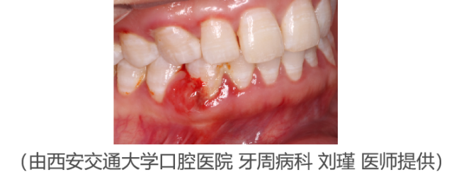 【口腔医学会专栏】牙龈瘤—长在牙龈上的"小疙瘩"