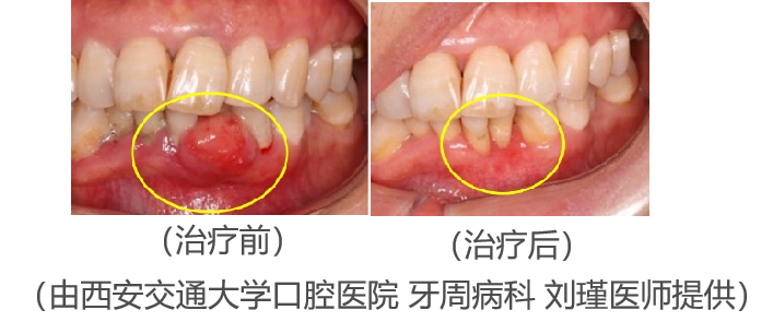 口腔医学会专栏牙龈瘤长在牙龈上的小疙瘩