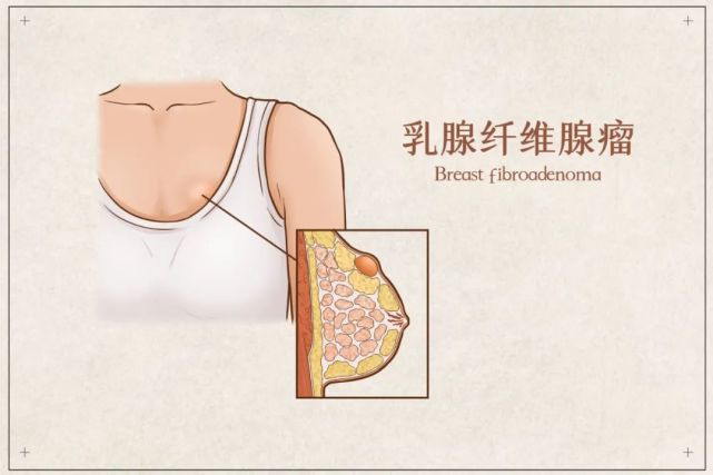 如何看待乳腺纤维腺瘤,会变成乳腺癌吗?