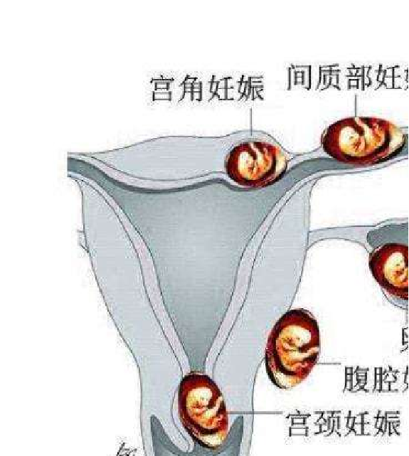 01)吸刮宫颈管术(编码:69.