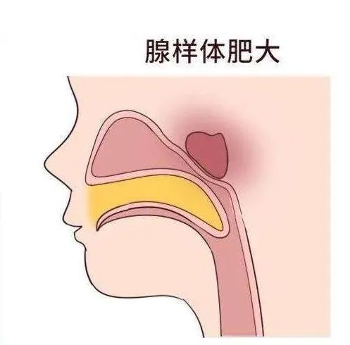 另一个易肥大成员——"腺样体",位置较隐蔽,在鼻咽部,所以知名度不高.