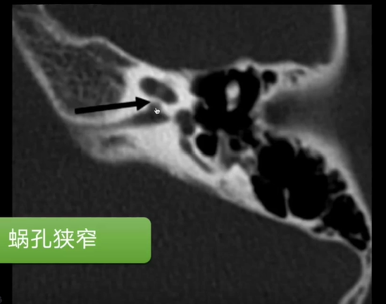 听神经从大脑经过内听道,经过蜗孔到达耳蜗,蜗孔狭窄意味着神经数量