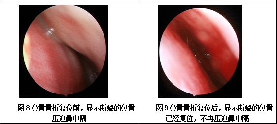 术后2周复查鼻面部消肿情况,主要看鼻骨复位满意度,内镜检查鼻中隔有