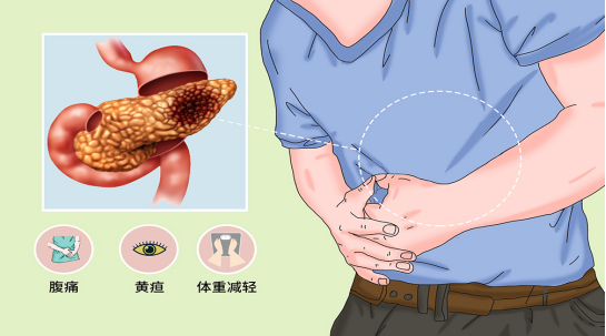哪些人容易患胰腺癌?