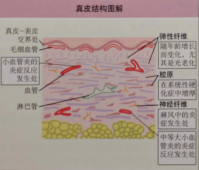 基底膜带结构破坏可能引起表皮和真皮分离,形成水疱.