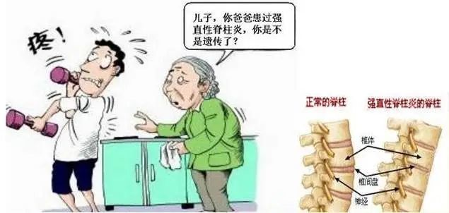 挺不起脊梁强直性脊柱炎到底该怎么办