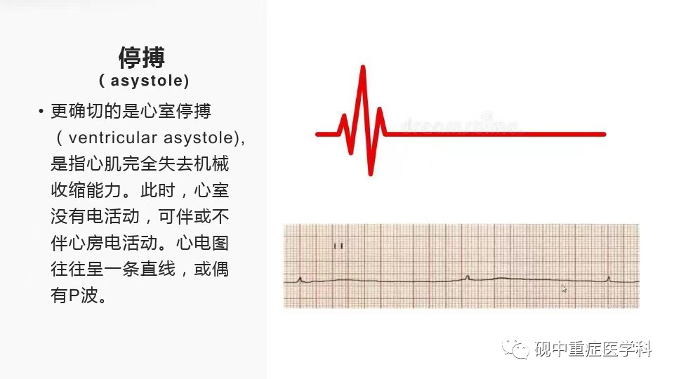 ppt心搏骤停的原因和临床表现