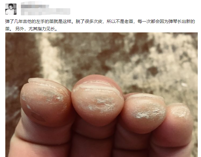 小提琴,吉他等弦乐的朋友,想要手不起茧是不可能的,而且练完琴,手指上