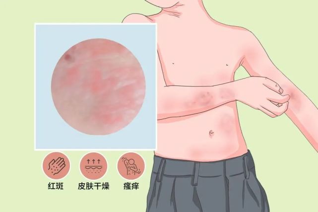 皮肤病也被称为「湿疹(atopic dermatitis,ad)特应性皮炎就真是「南