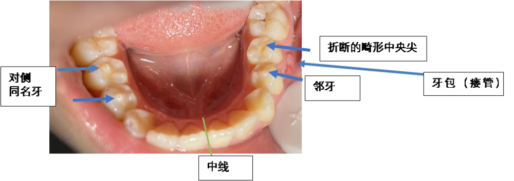 畸形中央尖属于牙齿发育异常,形态异常,是指在前磨牙或磨牙的咬合面