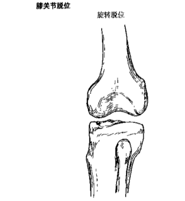 一文掌握|膝关节脱位的诊断及治疗