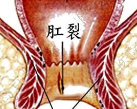 温州医博肛肠医院:"肛裂"该如何治疗?