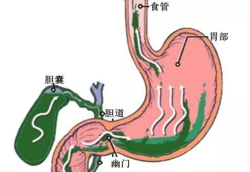 胆囊切除术后也会出现胆汁反流性胃炎.这是因为胆汁