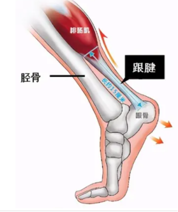 跟腱受到过度应力作用,反复牵拉而发生跟腱微小撕裂,产生无菌性炎症.