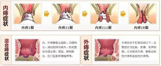 痔疮肉球如何消除医生支招轻松除痔消肉球