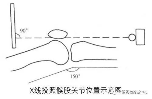 骨科技巧|教你如何快速准确判断x线片下"髌骨位置"