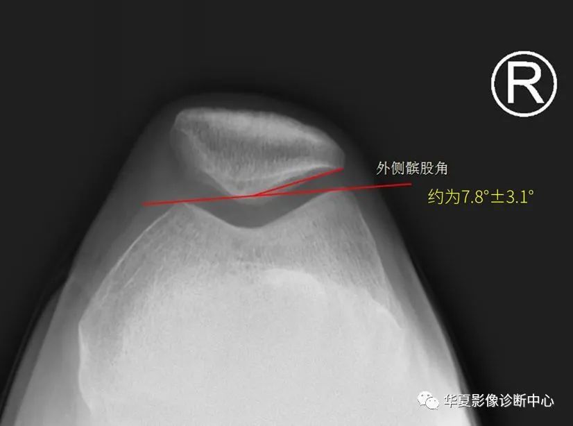 骨科技巧教你如何快速准确判断x线片下髌骨位置