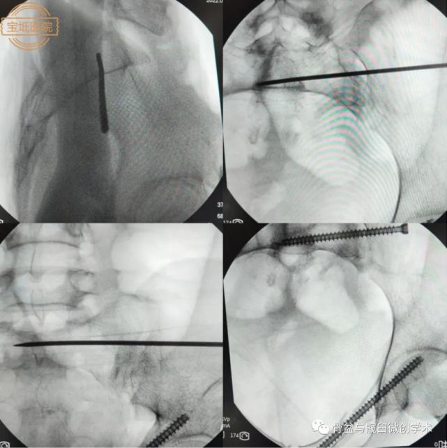 骶髂关节螺钉置入:确定一点:进钉点;一面:ct检查的横断面内(垂直于
