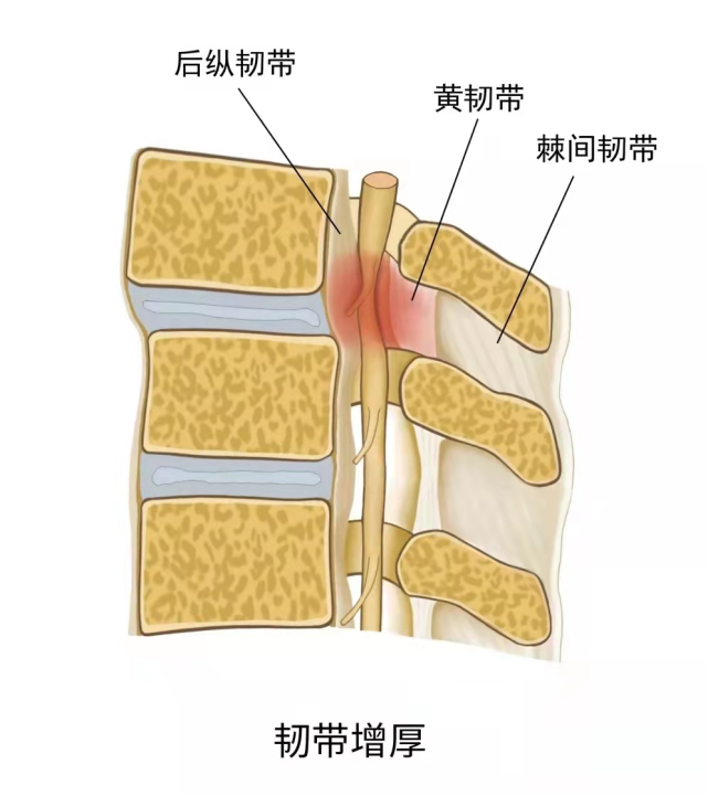 黄韧带肥厚或骨化是引起腰椎管狭窄的重要原因,当椎管已有狭窄或者