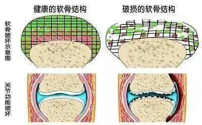 成都市骨科好的医院软骨磨损是骨关节炎根源软骨修复术可治愈骨关节炎