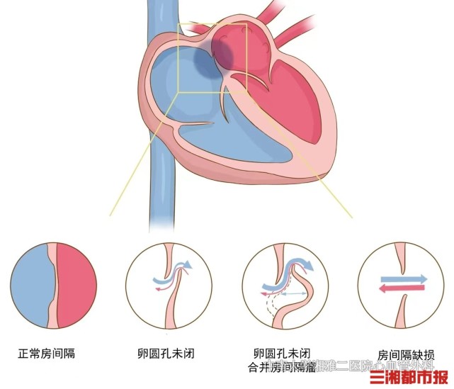 卵圆孔是胚胎时期胎儿心脏房间隔中部左右心房间的交通孔,是胎儿