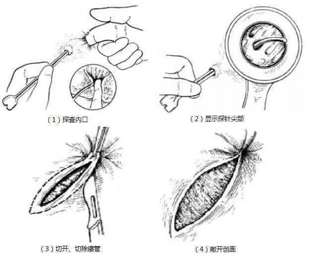 利用橡皮筋或有腐蚀作用的药线的机械性压迫作用,缓慢切开肛瘘的方法