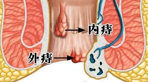 赣州华兴肛肠医院肛门硬硬的肉疙瘩很突然肿大是什么问题引起的