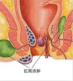 肛门周围(有的甚至会出现在外阴,会阴处)出现肿块或硬块,表皮发红