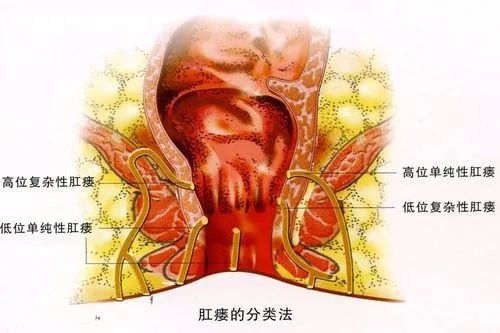 温州医博肛肠医院科普:肛瘘是怎么形成的?