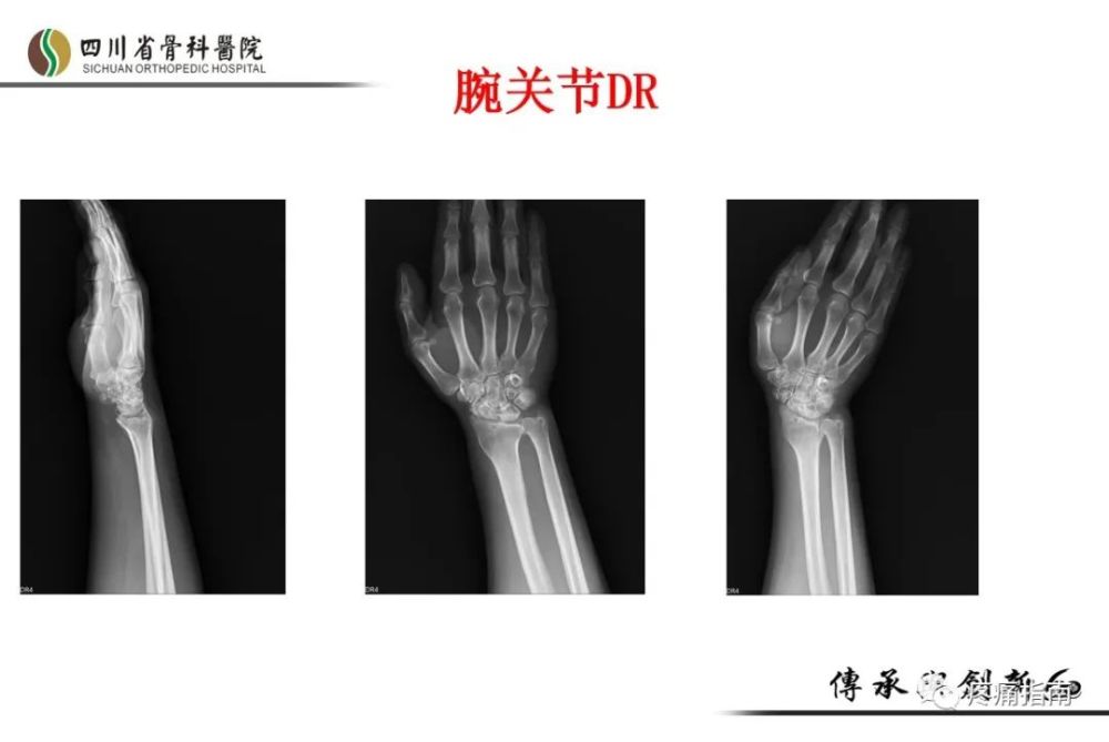 病例分享腕关节痛腕关节关节病腕管综合征