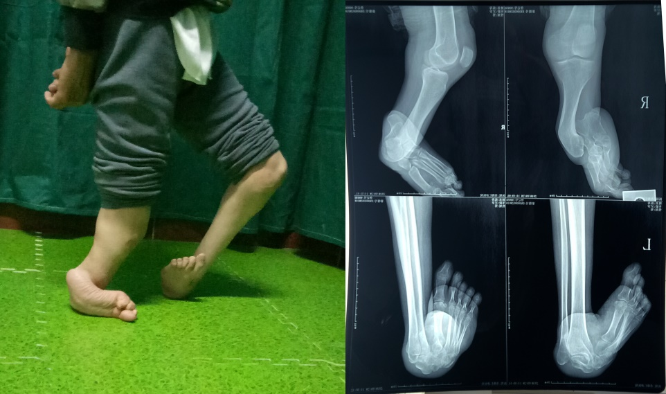 腓骨肌萎缩症,双重度马蹄内翻足畸形图2 男,35岁,右先天性胫骨缺如伴